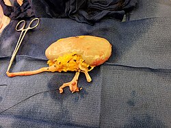 Kidney for transplant from live donor