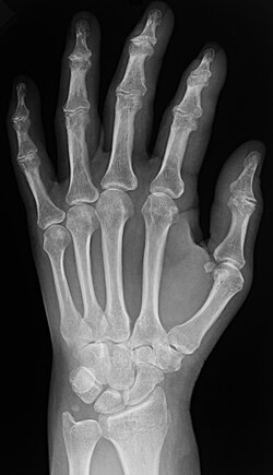 Plain X-ray of the wrist and hand
