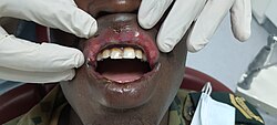 A woman who is suffering dental lesions