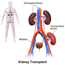 Kidney transplant