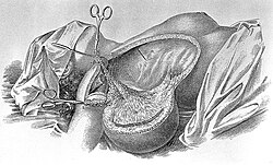 Radical mastectomy, Halsted's surgical papers