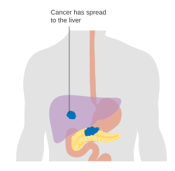 Pancreatic cancer metastasized – stage M1
