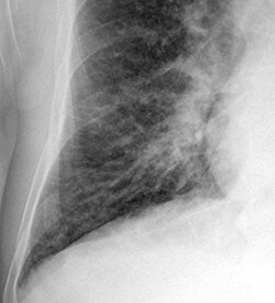 Kerley B lines in radiograph of acute cardiac decompensation. The short, horizontal lines can be found everywhere in the right lung.