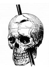 Phineas P. Gage survived an accident in which a large iron rod was driven completely through his head, destroying much of his brain's left frontal lobe, but the injury altered his personality and behavior.[261]
