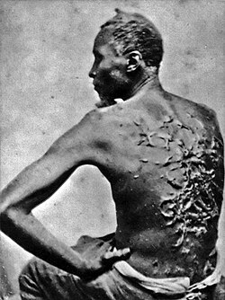 Scars on an enslaved man, Peter, April 2, 1863, Baton Rouge, Louisiana