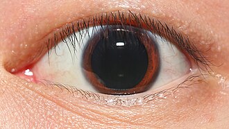 The pupil of the eye dilates in the dark to enhance night vision. Shown here is a pupil of an adult naturally dilated to 9 mm in diameter in mesopic light levels. The average human eye is not able to dilate to this extent without the use of mydriatics.