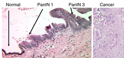 Micrographs of normal pancreas, pancreatic intraepithelial neoplasia (precursors to pancreatic carcinoma) and pancreatic carcinoma, H&E stain