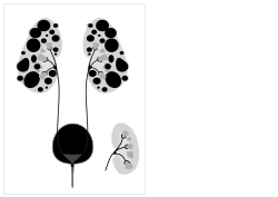 Cartoon of autosomal dominant polycystic kidney disease with normal kidney inset to right of diagram