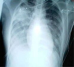 A chest x-ray of a patient with severe viral pneumonia due to SARS