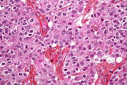 Micrograph of an oligodendroglioma, a type of brain cancer. Brain biopsy. H&E stain.