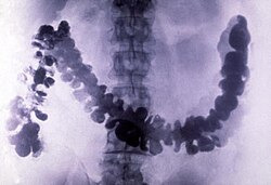 Amoebiasis as seen in a radiograph of a barium-filled colon