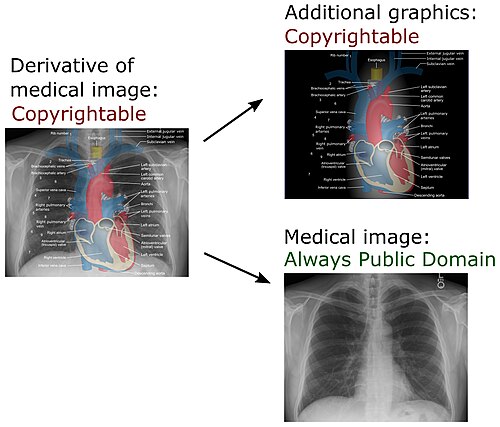 In U.S. law, this derivative work of a chest radiograph (which is in the public domain) is copyrightable because of the additional graphics. Yet the chest radiograph component of the work is still in the public domain.