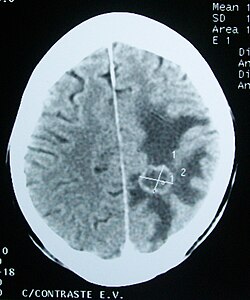 CT scan of a brain tumor, with its diameters marked as an X. There is hypoattenuating (dark) peritumoral edema in the surrounding white matter, with a "finger-like" spread.
