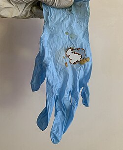 Nitrile glove exposed to drops of 98% sulfuric acid for 10 minutes