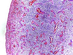 Micrograph showing granulation tissue. H&E stain.