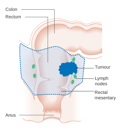 A diagram of local surgery for rectal cancer