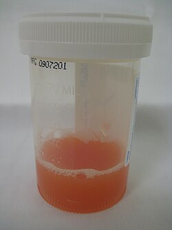 Appearance of synovial fluid from a joint with inflammatory arthritis